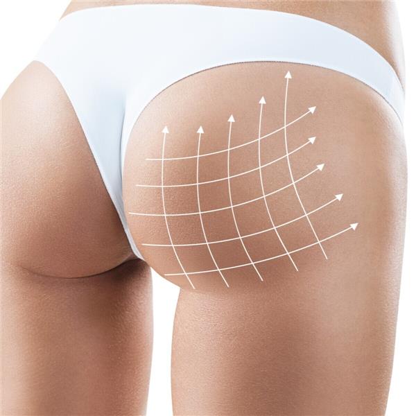 Alsancak Art’iz Beauty’de Popo Kaldırma veya Pop-Up uygulaması ile Popo sıkılaştırma ve Dikleştirme